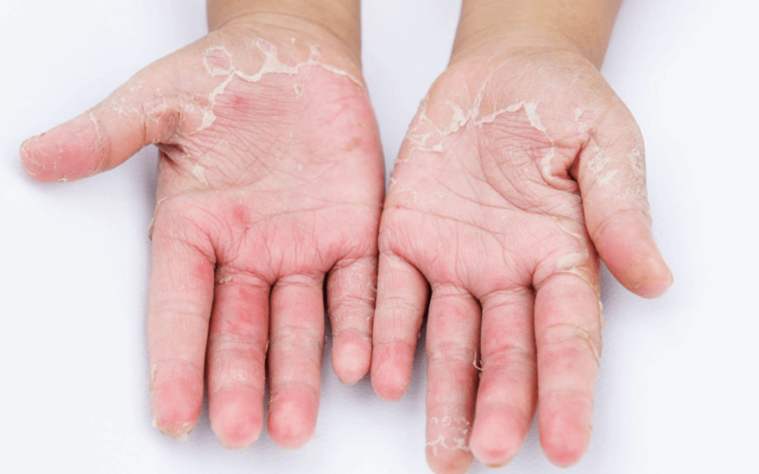 Najčešći uzroci i okidači kontaktnog dermatitisa