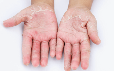 Najčešći uzroci i okidači kontaktnog dermatitisa