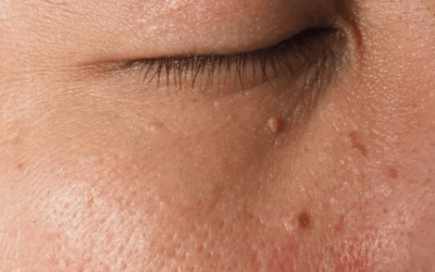 Vrste bradavica koje se mogu pojaviti na licu