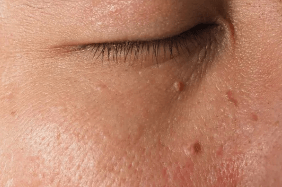 Vrste bradavica koje se mogu pojaviti na licu