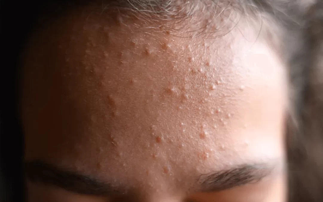 Komedoni na licu – zašto nastaju i zašto ih ne treba ignorirati