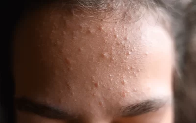 Komedoni na licu – zašto nastaju i zašto ih ne treba ignorirati