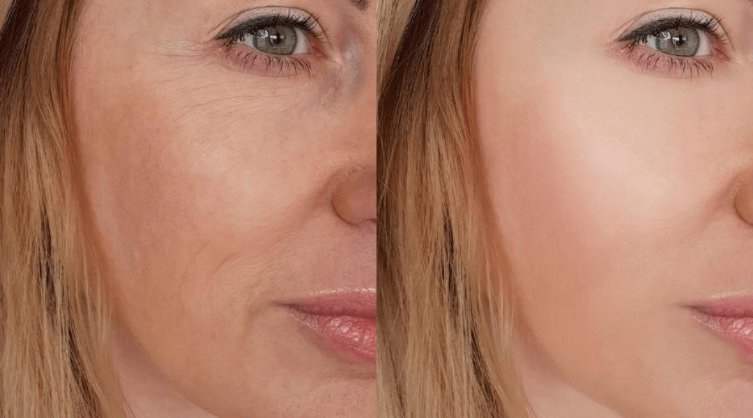 Donja trećina lica: zašto bore oko usana mijenjaju više nego što mislimo