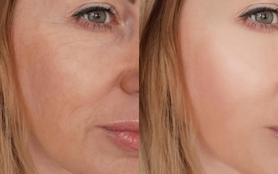 Donja trećina lica: zašto bore oko usana mijenjaju više nego što mislimo